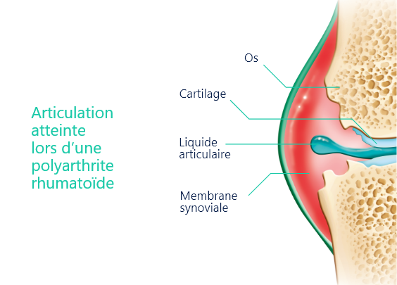 polyarthrite rhumatoïde